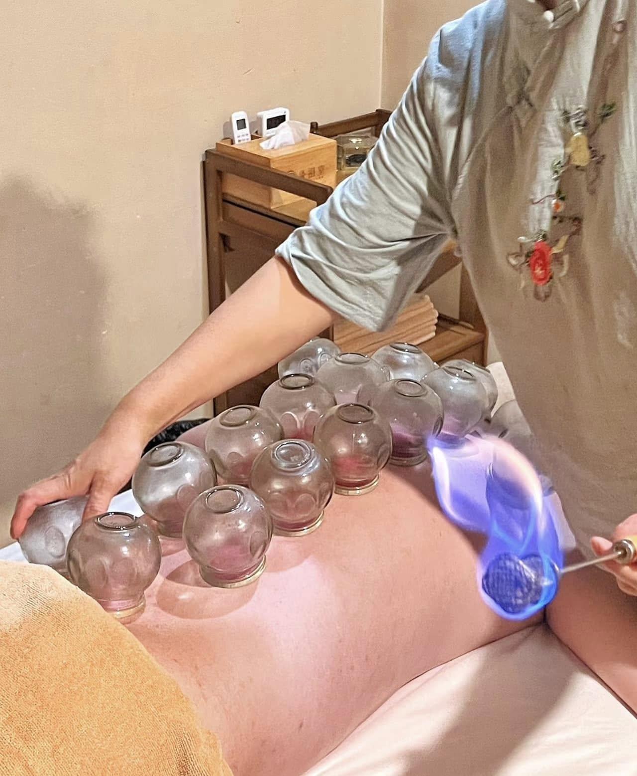 Cupping therapy in action